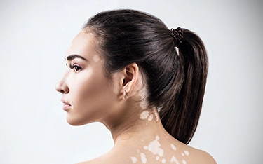 Vitiligo and Thyroid Connection: Understanding the Link