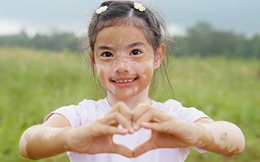 Is Vitiligo Hereditary?