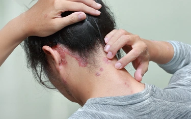 What causes Psoriasis of the scalp?