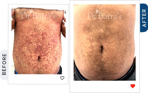 which-best-treatment-psoriasis-before-after-1