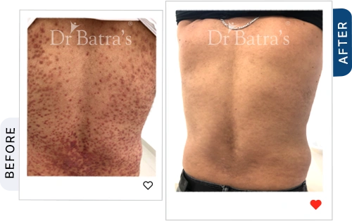 which-best-treatment-psoriasis-before-after-2