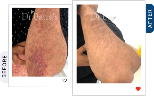 which-best-treatment-psoriasis-before-after-3