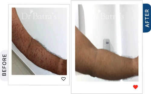 which-best-treatment-psoriasis-before-after-4