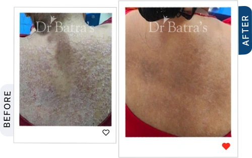 which-best-treatment-psoriasis-before-after-5