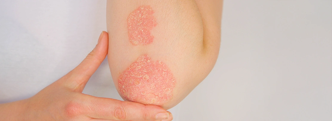 psoriasis