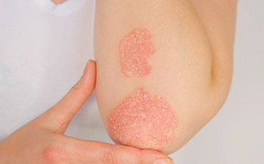 Best Treatment for Psoriasis: Effective Solutions for Clear Skin