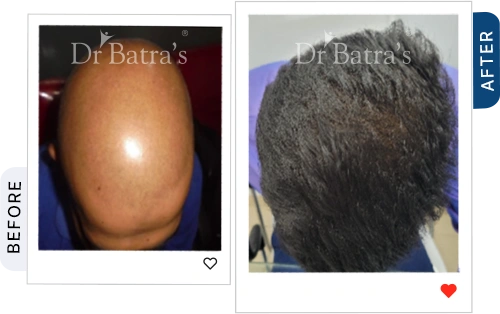 01-Alopecia-Before-After.webp