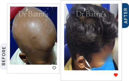 02-Alopecia-Before-After.webp