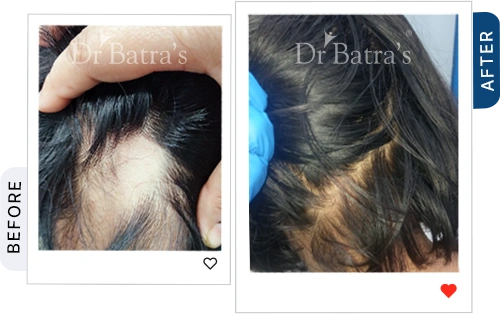 03-Alopecia-Before-After.webp