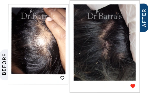 04-Alopecia-Before-After.webp