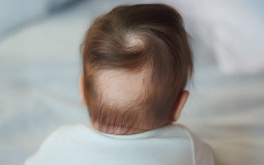 Alopecia Areata in Children - Signs & Treatment