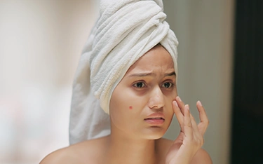 Can summer and heat cause acne breakouts?