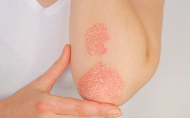 Is psoriasis an autoimmune disease?