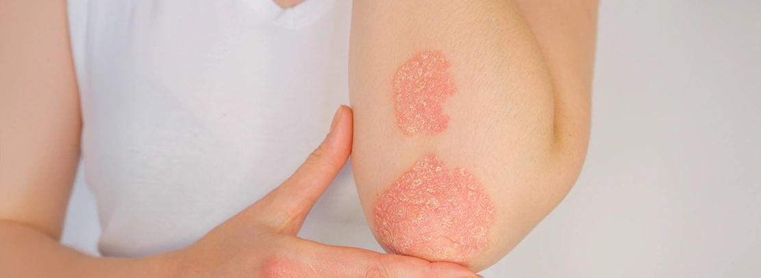 psoriasis