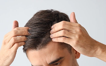seborrhoeic-dermatitissymptoms