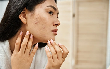 skin-diseasesacnetypes