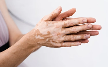 Vitiligo Causes: Why It Happens, What Triggers It & How to Control It