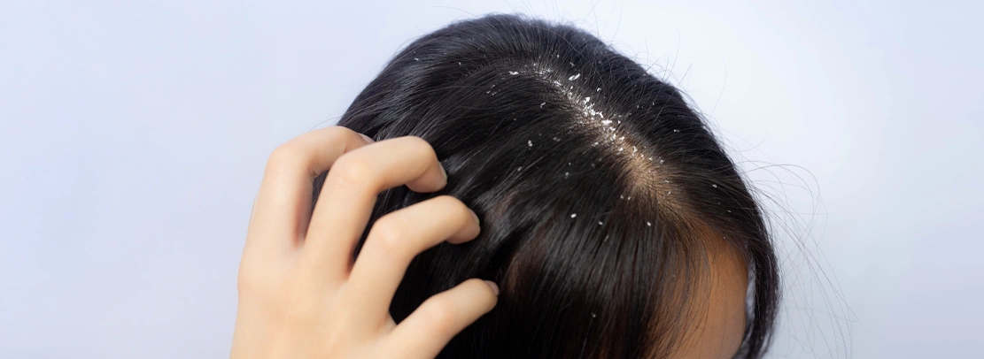 dandruff
