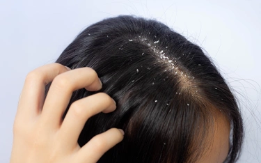 types-of-dandruff