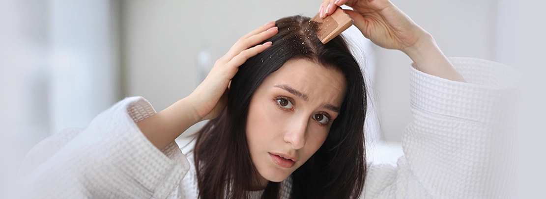 dandruff