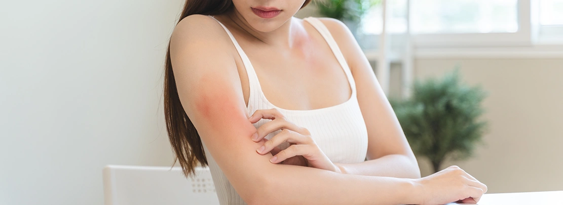 psoriasis