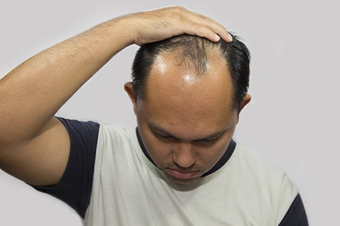 Male Pattern Baldness