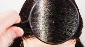 Seborrhoeic dermatitis - Natural treatment and remedies