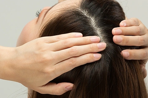 Female Pattern Baldness in 20s – Causes, Symptoms & Best Treatments