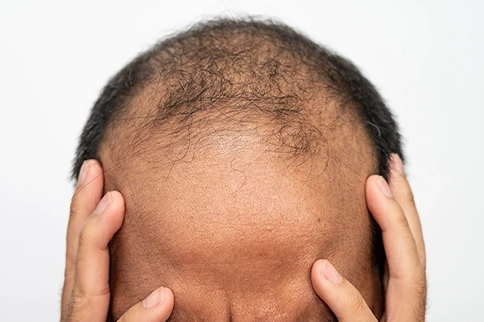 Can Alopecia Areata Turn Into Totalis?