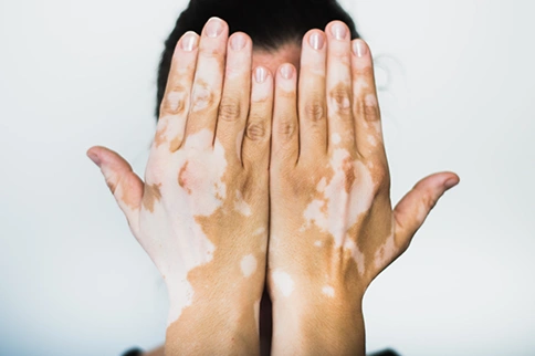Is It Safe to Get a Tattoo If You Have Vitiligo?