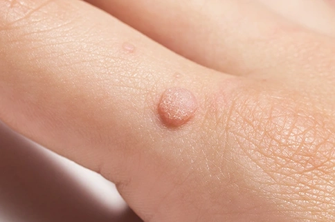 What are Genital Warts?