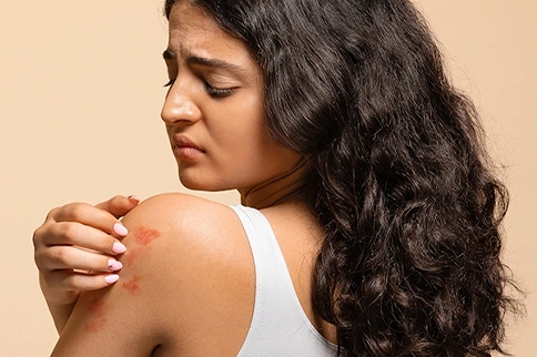 Epsom Salt for Psoriasis: Benefits & Soothing Baths