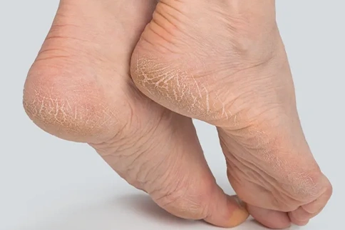 Homeopathy… A good solution for Cracked Heels