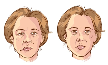HOMEOPATHY & BELL’S PALSY