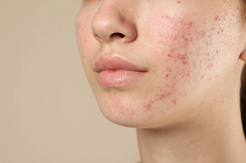 post summer pigmentation