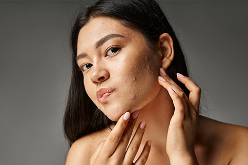 Acne in women after 30
