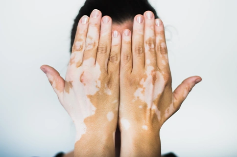 difference vitiligo white patch