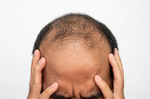 hair loss in man