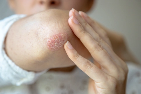 monsoon skin problems