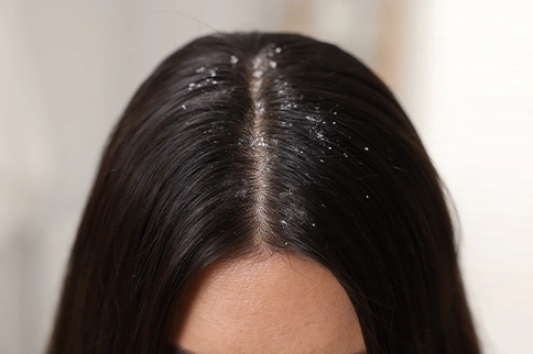 Homeopathic Medicine Helped My Scalp