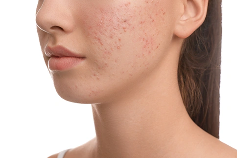 acne