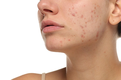 Are acne scars more than skin