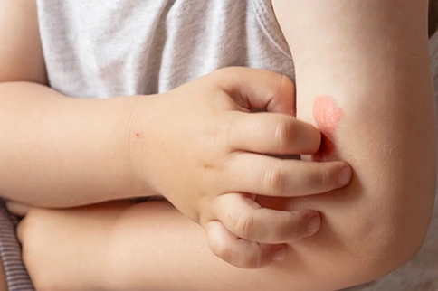 Atopic Dermatitis