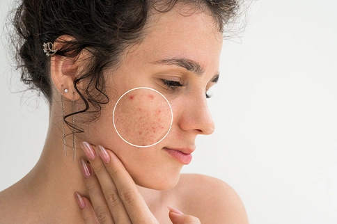 Best Remedy for Acne