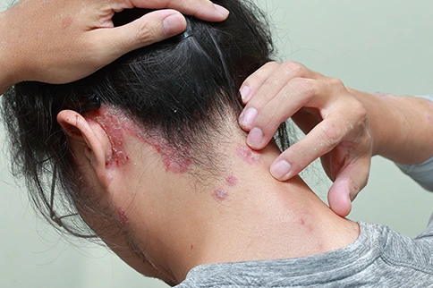 psoriasis