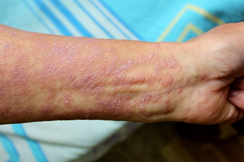 Freedom from lesions of Lichen Planus