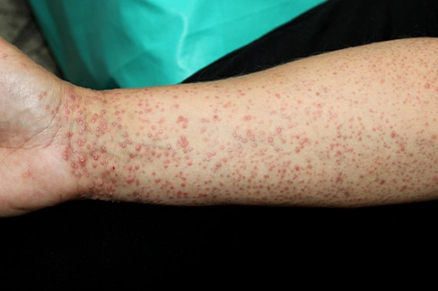 Heal your Lichen Planus
