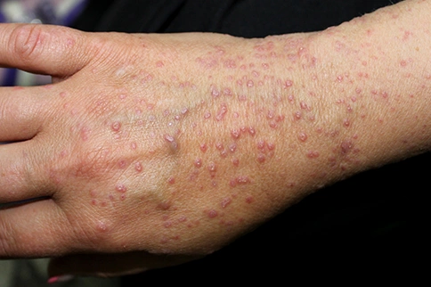 How long does lichen planus take to clear up?