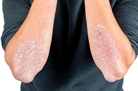 psoriasis
