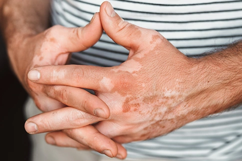 Leucoderma